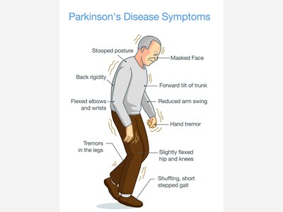 Parkinson’s Disease: May Go Unnoticed for Years