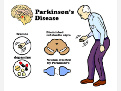 Understanding Parkinson's Disease